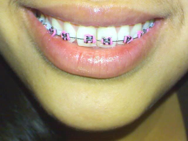 white braces
