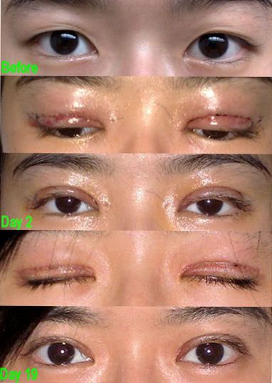 How long does it usually take to recover from upper eyelid surgery?