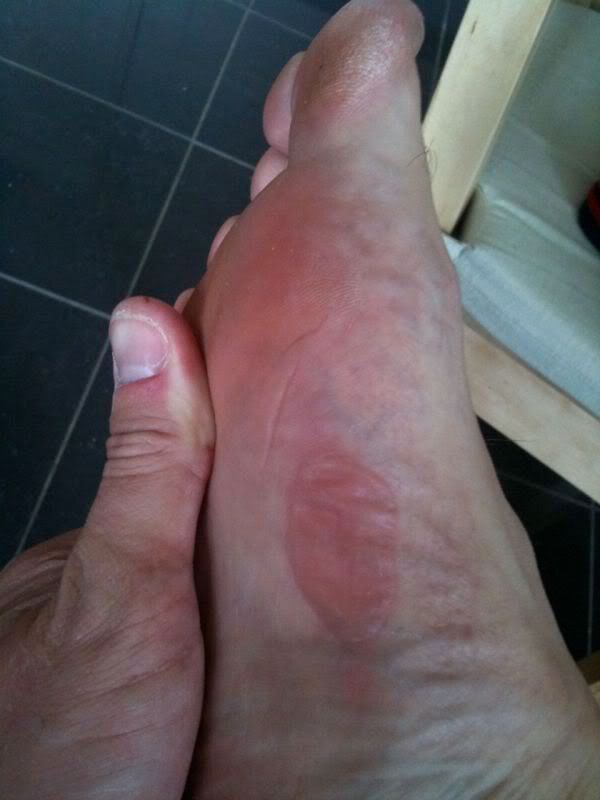 Blisters on instep when running hills Runners Forum