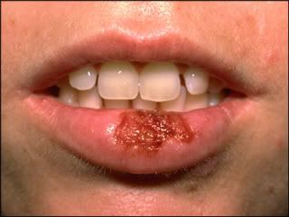 Cold Sore Pictures - Late Stage Cold Sore, Almost Fully Crusted Over.