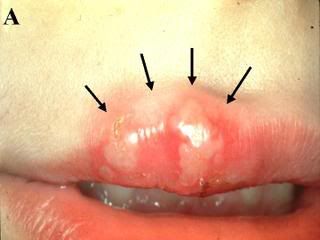 Fully Developed Cold Sore Picture