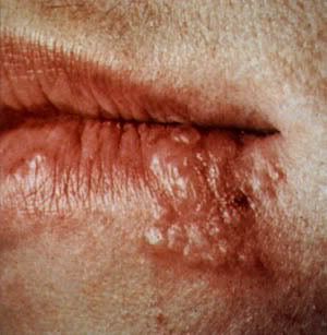 Another cold sore towards the end of the middle stage, you can see it just starting to crust over on the right.
