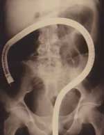 colonoscopy.jpg