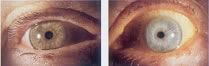 constricted_pupils.jpg