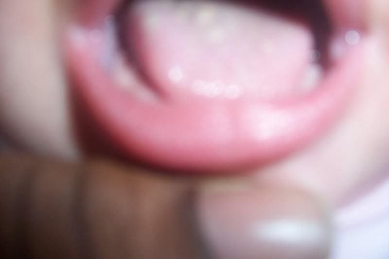 Lump Under Tongue