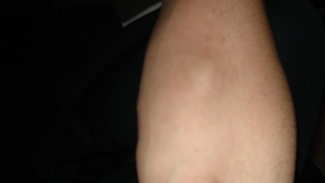 Small Lump On Upper Arm Muscle 63
