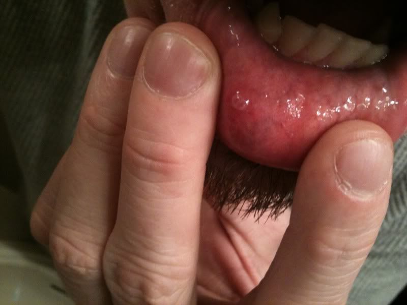 Small,Clear bump in my lower lip inside my mouth? | Yahoo ...