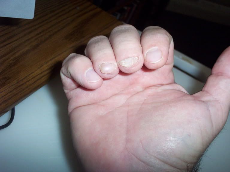 Missing middle finger tip help - Guitar Tricks Forum